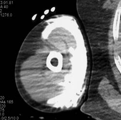 Contrast Extravasation - CTisus CT Scan