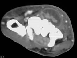 Abscess - CTisus CT Scan