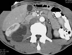 Psoas Abscess - CTisus CT Scan