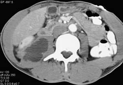 Psoas Abscess - CTisus CT Scan