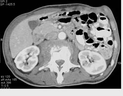 Tuberculosis (TB) Osteomyelitis With Psoas Abscess - CTisus CT Scan