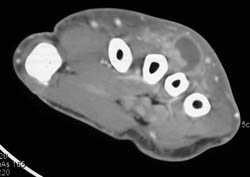 Abscess in Dorsum of the Hand - CTisus CT Scan