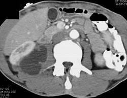 Psoas Abscess - CTisus CT Scan