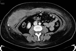 Abdominal Wall Hematoma - CTisus CT Scan