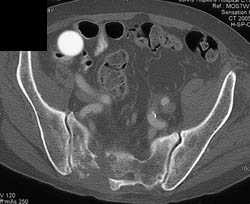 Chordoma - CTisus CT Scan