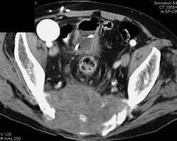 Chordoma - CTisus CT Scan