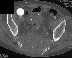 Chordoma - CTisus CT Scan