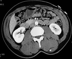 Bleed in Left Paraspinal Muscle - CTisus CT Scan