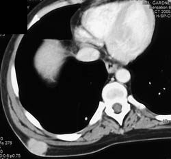 Lymphoma - CTisus CT Scan