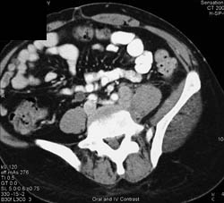 Sarcoma Invades SI Joint - CTisus CT Scan