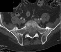 Fusion Right SI Joint - CTisus CT Scan