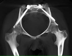 Pelvic Reconstruction - CTisus CT Scan