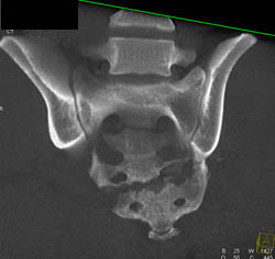 Sacral Fracture - CTisus CT Scan