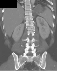 T-spine Fracture- Unstable - CTisus CT Scan