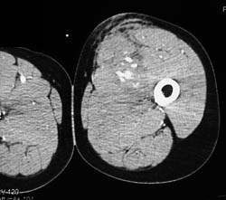 Bleed in Thigh S/P GSW - CTisus CT Scan