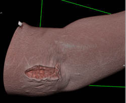 Stab Wound - CTisus CT Scan