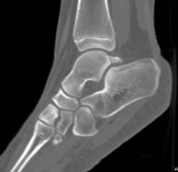 Beak  Off Talus and Unusual Osteophytes - CTisus CT Scan