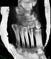 Lisfranc Fracture - See Tarsal Metatarsal Row - CTisus CT Scan