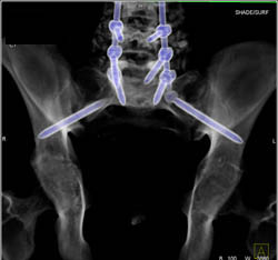 Surgical Fusion - CTisus CT Scan