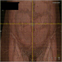 Flap Planning - CTisus CT Scan