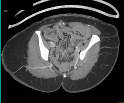 Hypogastric Mapping - CTisus CT Scan