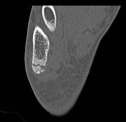 Base of 5th Fracture - CTisus CT Scan