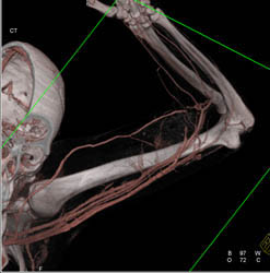 CTA With Abscess at Elbow - CTisus CT Scan