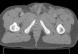 Early Necrotizing Fasciitis- Fourniers Gangrene - CTisus CT Scan