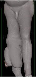 Severe Lymphedema - CTisus CT Scan