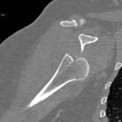 Fracture and Anterior Dislocation - CTisus CT Scan