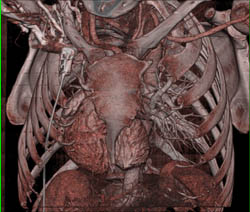 Unusual Shaped Shield Sternum - CTisus CT Scan