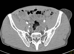 Lipoma Left Thigh Presents as Mass - CTisus CT Scan