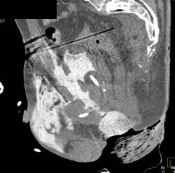 Pelvic Fractures With Bladder Rupture - CTisus CT Scan