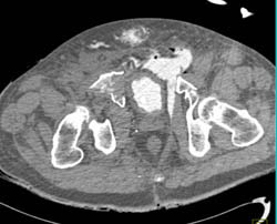 Symphysis Fracture With Bladder Laceration and Contrast Extravasation - CTisus CT Scan