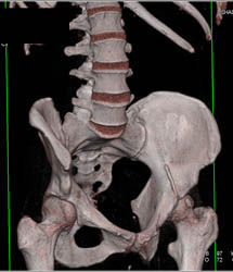 3D VRT Bone and Soft Tissue- See Disc Spaces - CTisus CT Scan