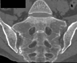 Myeloma Infiltrates the Sacrum - CTisus CT Scan