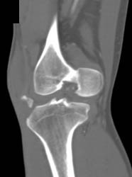 Trauma to Knee Without Vascular Injury - CTisus CT Scan