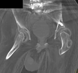 Congenital Hip Disease With Poor Coverage of Left Femur - CTisus CT Scan