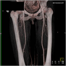 Normal Superficial Femoral Artery (SFA) - CTisus CT Scan