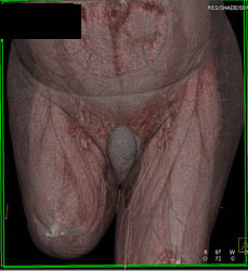 AKA (above-the-knee amputation) With Good Post Surgical Changes - CTisus CT Scan