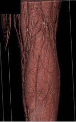 Normal Vessel Trifurcation S/P Soft Tissue and Muscle Trauma - CTisus CT Scan