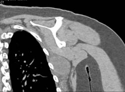 Sarcoma Axilla - CTisus CT Scan