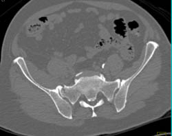 Fracture Through SI Joint - CTisus CT Scan