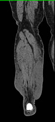 Cellulitis - CTisus CT Scan