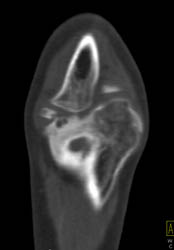 Repeated Trauma to Elbow - CTisus CT Scan