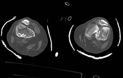 Bilateral Femur Fractures - CTisus CT Scan