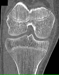 High Resolution Details of Epiphysis - CTisus CT Scan