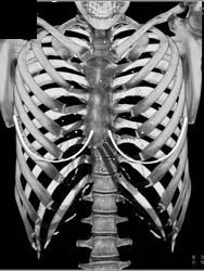 Pectus Deformity for Pre-op Planning - CTisus CT Scan