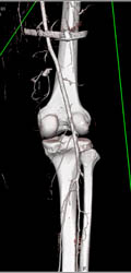 GSW Thigh With Active Bleeding Site Defined - CTisus CT Scan