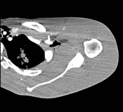 GSW Shoulder Without Vascular Injury- Multiple Renderings and Edits With Bone Removed - CTisus CT Scan